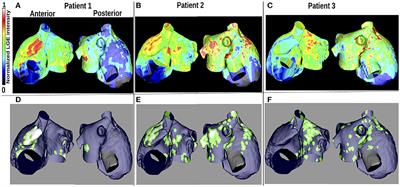 Wavelength and Fibrosis Affect Phase Singularity Locations During Atrial Fibrillation